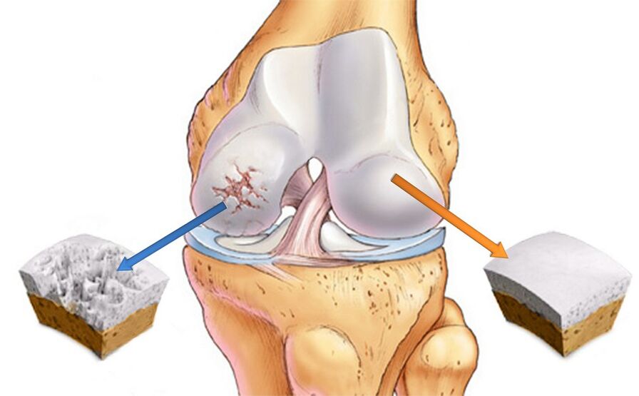 Knee articulation arthrosis