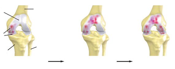 The degree of arthrosis of the knee articulation