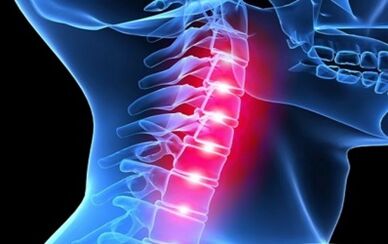 Symptoms of cervical spine osteochondrosis