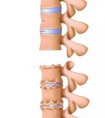 Osteochondrosis Ramps of the Neck