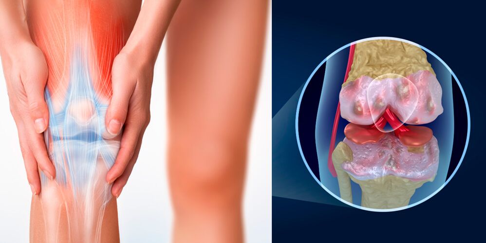 severe knee pain