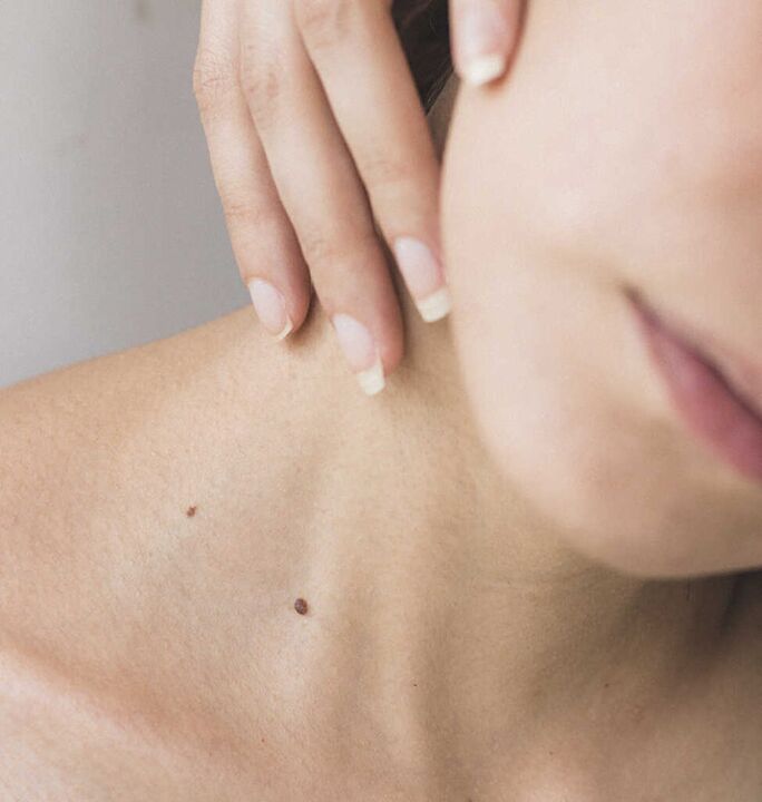 Stiff neck is one of the symptoms of the initial stage of osteochondrosis of the cervical spine